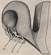 Description : L'artère hyaloide H pénètre par la fente colobomique